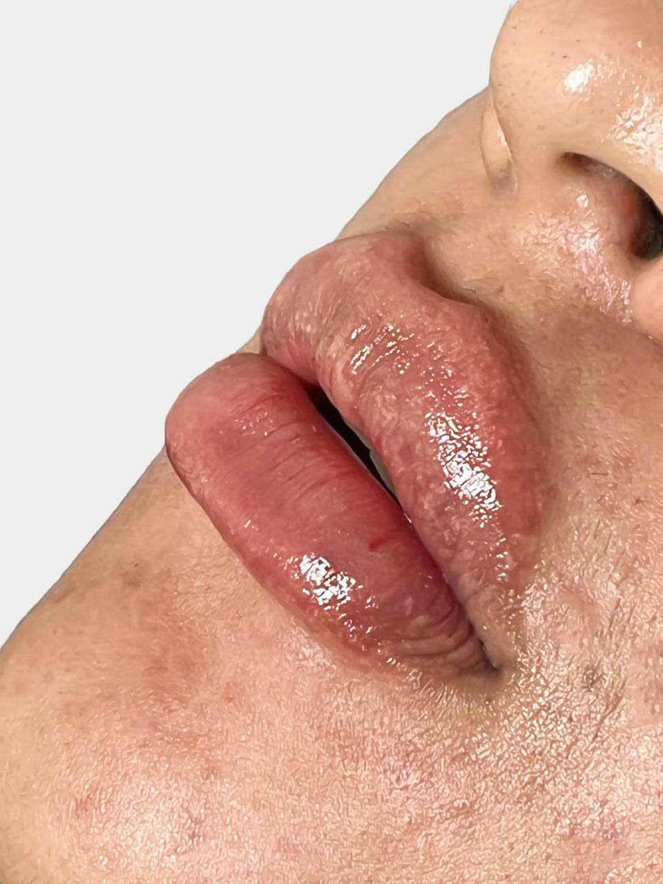 Después de Fillers de Labios